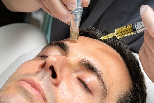 microneedling-man